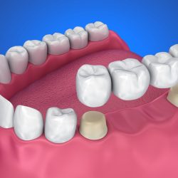 cantilever bridge dental