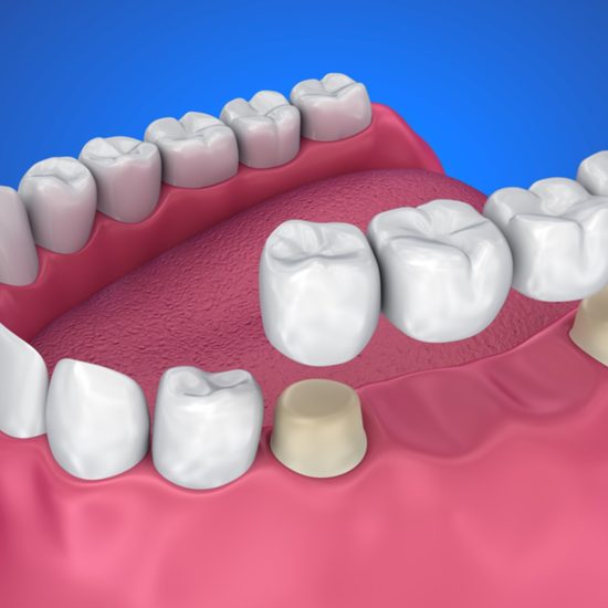 cantilever bridge dental