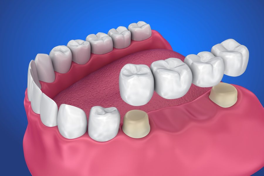 cantilever bridge dental