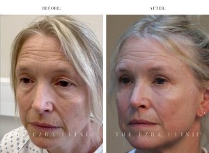 Eye Lift Surgery Before and After