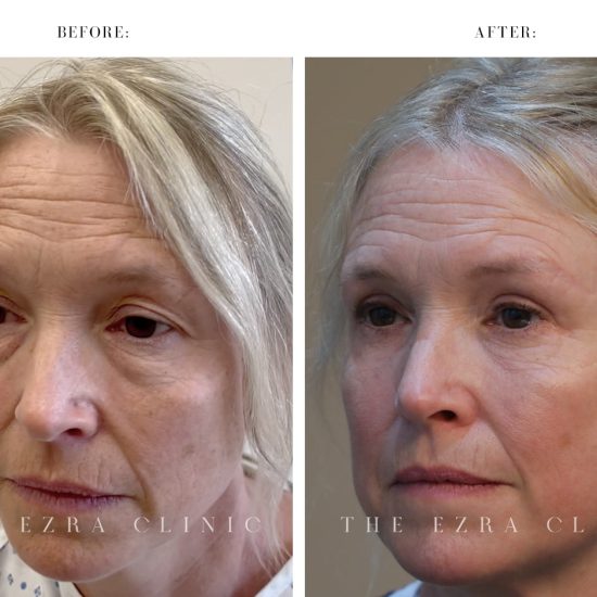 Eye Lift Surgery Before and After