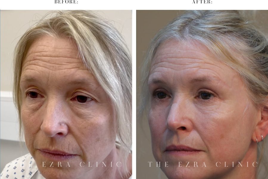 Eye Lift Surgery Before and After